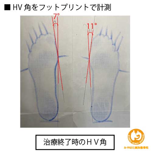 (初診時のフットプリント)外反母趾(症例1)41歳女性