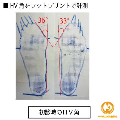 （初診時のフットプリント）外反母趾（症例５）４５歳女性