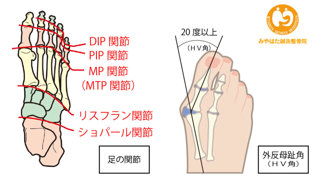 外反母趾の定義説明図